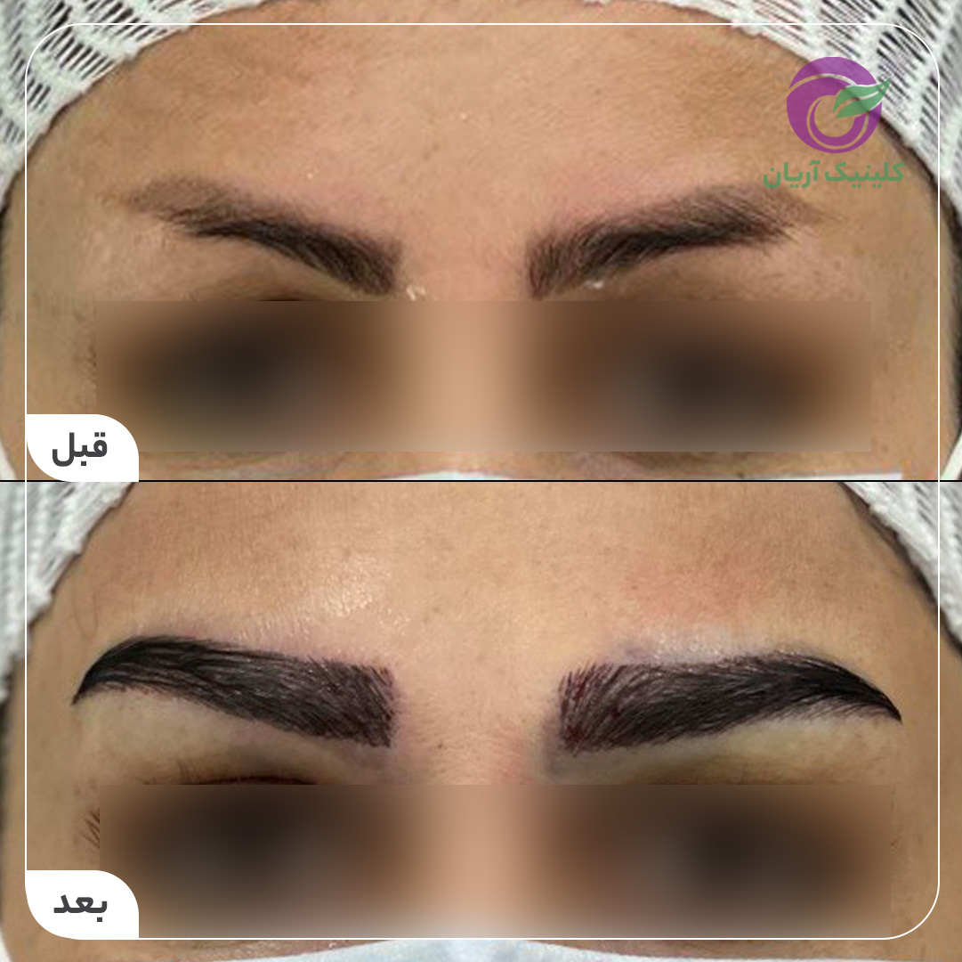 گالری فیلم کاشت ابرو